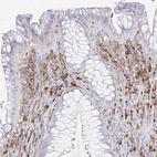 Immunohistochemical staining of human rectum shows strong cytoplasmic positivity in lymphoid cells.